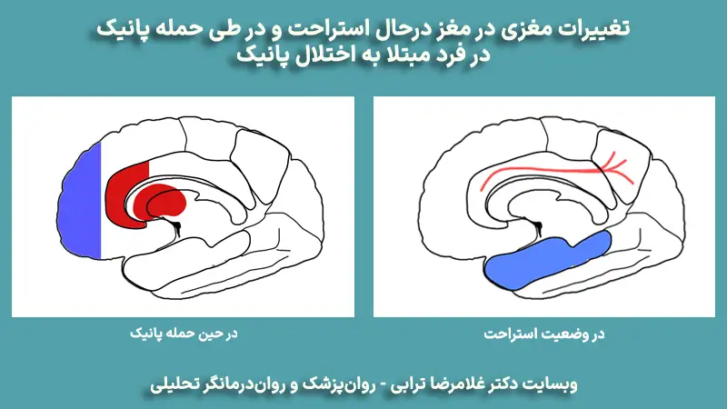 اختلال پانیک: تغییرات مغزی - دکتر ترابی